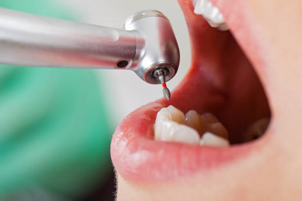 Best Emergency Tooth Extraction in Wilson, NC
